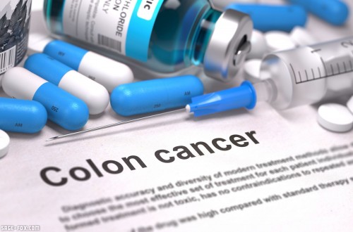 ColonCancer_335726570.jpg